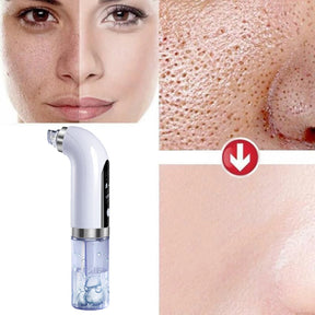 Removedor de Cravos | SkinRenew Max®